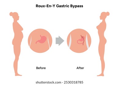 Roux-en-y gastric bypass, weight loss surgery. Gastroenterology medical disease