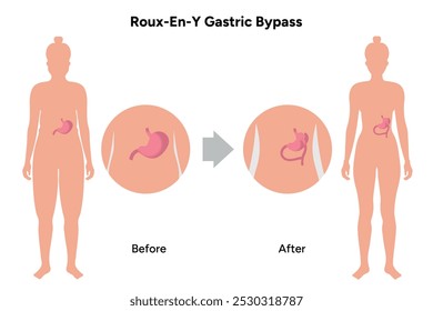 Roux-en-y gastric bypass, weight loss surgery. Gastroenterology medical disease