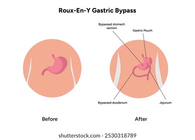 Roux-en-y gastric bypass, weight loss surgery. Gastroenterology medical disease