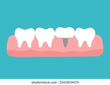 Row of healthy teeth and one tooth replaced with an implant. Vector hand-drawn illustration in flat style. Dental treatment, oral hygiene concept.