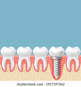 Row of teeth with dental implant - teeth prosthetics scheme, gum cut