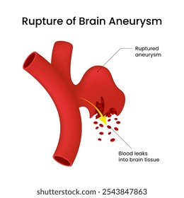 Ruptura do aneurisma cerebral