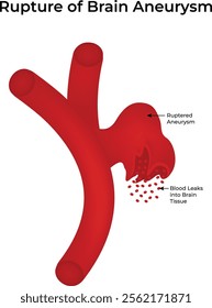 Rupture of Brain Aneurysm Science Design Vector Illustration Diagram