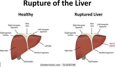 Rupture Of The Liver