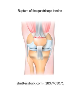 Rupture of the quadriceps tendon. Knee joint with patella and Tendon Tears.