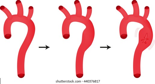 Ruptured Aortic Aneurysm