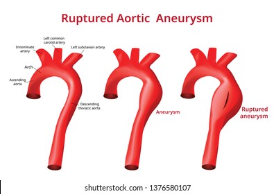 Ruptured Aortic Aneurysm, Aortic Disease, Vector