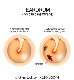 Ruptured eardrum. Anatomy of the humans eardrum. Healthy and perforated tympanic membrane. Vector illustration for medical, science, and educational use