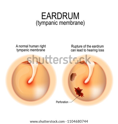 Ruptured eardrum. Anatomy of the humans eardrum. Healthy and perforated tympanic membrane. Vector illustration for medical, science, and educational use Foto stock © 