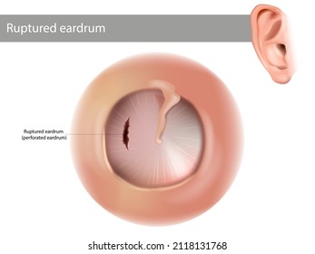 Ruptured eardrum or perforated eardrum. Tympanic membrane perforation.