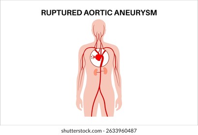 Brutales Aortenaneurysma im menschlichen Körper. Bluthochdruck, Entzündung in männlicher Silhouette. Vergrößerter Brustkorbabschnitt. Diagramm der Blutgefäße, medizinischer flacher Vektor