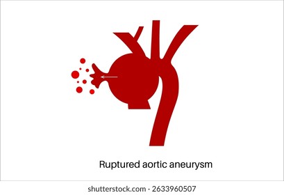 Brutales Aortenaneurysma im menschlichen Körper. Bluthochdruck, Entzündung im Brustbereich. Vergrößerter Brustkorbabschnitt. Diagramm der Blutgefäße, medizinische Vektorgrafik