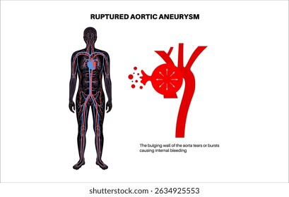 Ruptured thoracic aortic aneurysm in the human body. Pain, pressure, bulge or inflammation on chest. Enlarged section of thoracic aorta. Medical diagram with dilated blood vessels vector illustration