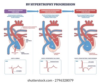 RV hypertrophy progression diagram explains afterload to failure, with right ventricle, pulmonary artery, and ECG leads illustrating thickening, dilation, and strain. Outline diagram