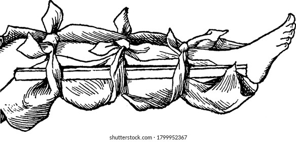 Tira S de material rígido utilizado para apoyar e inmovilizar un hueso roto cuando se ha fijado, dibujo de línea vintage o ilustración de grabado.
