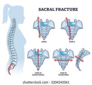 Sacral fracture with backbone skeletal trauma or injury types outline diagram. Labeled educational scheme with broken longitudinal and transverse zone vector illustration. Vertebrae accident anatomy.