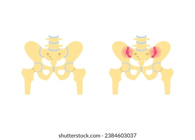 Inflamación de las articulaciones sacroiliacas. Ilustración médica de vectores. 