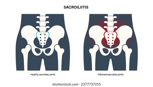 Sacroiliitis disease concept. Inflamed sacroiliac joints. Lower spine and pelvis inflammatory connection. Pain, stiffness in the buttocks or lower back, sacrum problem, anatomical vector illustration