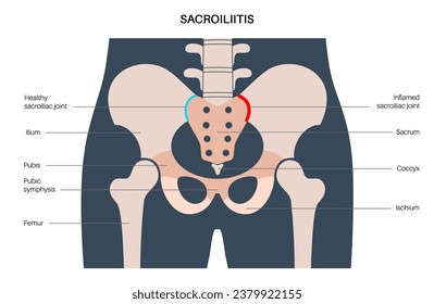 Sacroiliitis disease concept. Inflamed sacroiliac joints. Lower spine and pelvis inflammatory connection. Pain, stiffness in the buttocks or lower back, sacrum problem, anatomical vector illustration