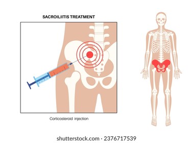 Sacroiliitis disease, corticosteroid injections, diagnosis and treatments in clinic. Inflamed sacroiliac joints. Pain in lower spine and pelvis inflammatory connection medical vector illustration