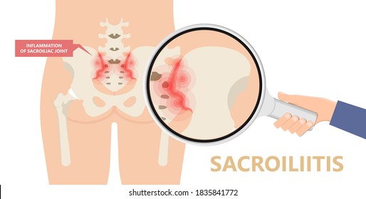 Sacroiliitis pain of sacroiliac joints and hips lupus legs physical exam ulcerative colitis infection swelling ligaments breakdown psoriasis Trauma Obesity Gout
