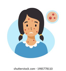 Sad  girl with chicken pox on her face. Skin inflammation and acne in adolescents.