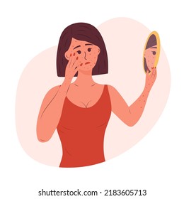 Sad Woman With A Rash On Her Face And Hands Looks In The Mirror. Monkeypox Virus, Allergic Itch, Skin Inflammation, Redness, Irritation, Psoriasis, Atopic Dermatitis, Eczema. 