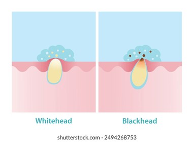 Salicylic acid treat whitehead and blackhead acne pimple vector illustration. Beta hydroxy acid, BHA penetrate into skin to dissolve open and closed plugged pore the dead skin cell and excess oil.