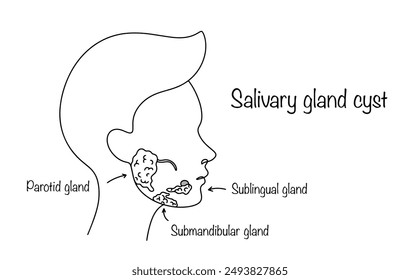 A salivary gland cyst causes a disruption of salivary outflow. A cyst is formed as a result of injury or some kind of inflammation. Visual medical illustration.