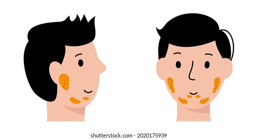 Salivary Gland In Human Mouth. Parotid, Submandibular, And Sublingual Glands. Produce Of Saliva Through A System Of Ducts. Xerostomia Oral Disease Anatomical Poster. Medical Flat Vector Illustration.