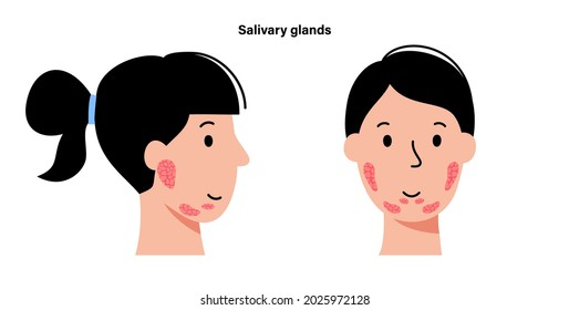 Salivary gland in human mouth. Parotid, submandibular, and sublingual glands. Produce of saliva through a system of ducts. Xerostomia oral disease anatomical poster. Medical flat vector illustration.