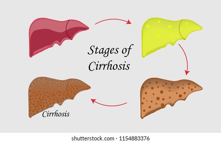 35 Liver due to alcohol Images, Stock Photos & Vectors | Shutterstock