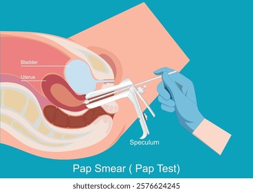 Sampling the endocervix using the cervical brush.Pap Smear( Pap Test).Thin Prep Plus Cervista HPV DNA Testing, Cervical Cancer Screening, medical healthcare, vector illustration.