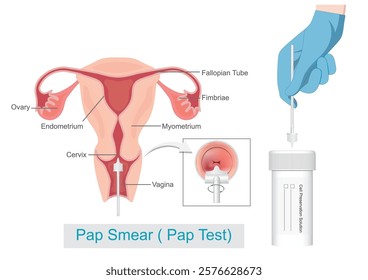 Sampling the endocervix using the cervical brush and cell preservation solution. Cervical Cancer Screening, Pap Smear ( Pap Test), Thin Prep Plus Cervista HPV DNA Testing, medical healthcare. 