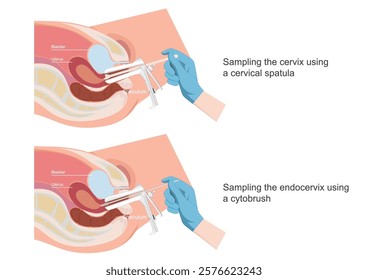 Sampling the endocervix using the endocervical brush and using the cytobrush.Cervical Cancer Screening, Pap Smear ( Pap Test), medical healthcare vector illustration.