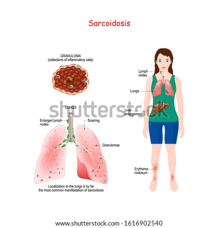 Sarcoidosis signs and symptoms. Development of granulomas (little tumors). vector illustration. Labeled medical scheme Stock photo © 