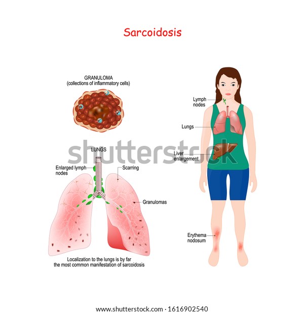 Sarcoidosis Signs Symptoms Development Granulomas Little Stock Vector ...