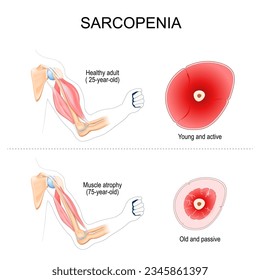 sarcopenia. Comparison and Difference between muscles of Healthy adult and arm with atrophy. Cross section of muscle of Young active person, and Old passive human. Vector illustration