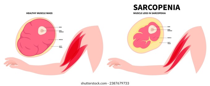 The Sarcopenia disorder that cause arm and leg muscle loss in older adults with body nerve pain injury of limb by low nutrition after aging