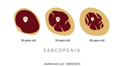 Sarcopenia In Elderly. Replacement Of Muscle Tissue With Fat In Aging Process. Vector Illustration