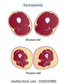 Sarcopenia, pérdida de masa muscular e ilustración del vector de fuerza aislada en el fondo blanco. Sección transversal de la pérdida de masa muscular del hombre sedentario en diferentes edades. Anatomía y concepto de atención de la salud.
