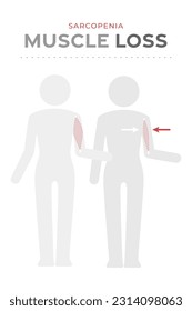 Sarcopenia, muscle loss icon.
Human body pictogram with healthy muscle mass and  muscle loss.
Muscular pathology medical infographic vector. Sarcopenia in elderly. Large and small biceps on the arm
