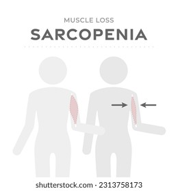 Sarcopenia, sistema médico de pérdida muscular. Ilustración vectorial con pictograma corporal humano comparando la masa muscular saludable normal y el músculo viejo débil atrofiado en el proceso de envejecimiento.
