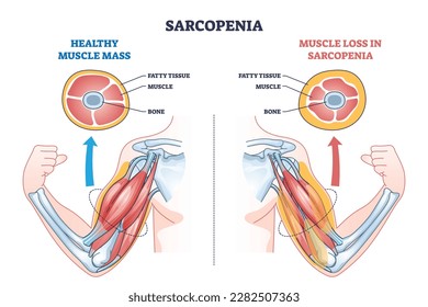 Sarcopenia como pérdida de masa muscular y esquema de crecimiento de tejido graso. El esquema médico educativo etiquetado con envejecimiento causó debilidad e ilustración de vector de patología muscular. Problema de salud de obesidad.