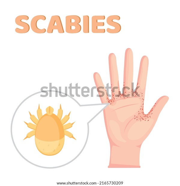 Sarcoptes Scabiei Scabies Sexually Transmitted Disease Stock Vektor Royaltyfri 2165730209 0231