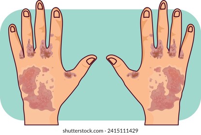 scabies on the finger and dorsal of the hands