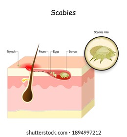 Scabies. seven-year itch is a contagious skin infestation by the mite Sarcoptes scabiei. Skin with eggs and mite in a burrow. Close-up of Scabies mite. Vector illustration