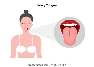 Scalloped Wavy tongue, medical infographic 