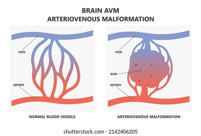 Scalp Brain Ct Scan X-ray Image Mri Diagnose Blood AVM Artery Veins Flow Stroke Loss Of Optic Nerve Pain Head Galen Swelling Tangle Capillaries System Nidus Cerebral Attack Transient Dural Fistula