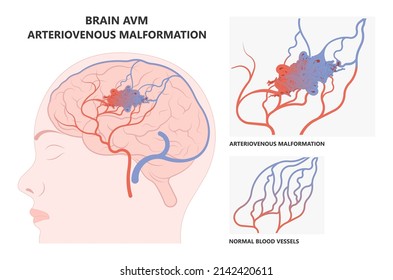 Scalp Brain Ct Scan X-ray Image Mri Diagnose Blood AVM Artery Veins Flow Stroke Loss Of Optic Nerve Pain Head Galen Swelling Tangle Capillaries System Nidus Cerebral Attack Transient Dural Fistula